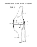 METHOD AND APPARATUS FOR FEMORAL RESECTION ALIGNMENT diagram and image