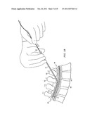 APPARATUS FOR IMPLANTING AN ELECTRICAL STIMULATION LEAD diagram and image