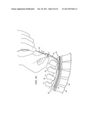 APPARATUS FOR IMPLANTING AN ELECTRICAL STIMULATION LEAD diagram and image