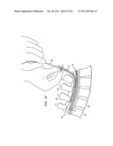 APPARATUS FOR IMPLANTING AN ELECTRICAL STIMULATION LEAD diagram and image