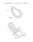 SELECTIVELY ADJUSTABLE CARDIAC VALVE IMPLANTS diagram and image
