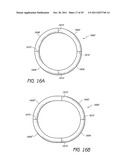 SELECTIVELY ADJUSTABLE CARDIAC VALVE IMPLANTS diagram and image