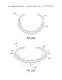 SELECTIVELY ADJUSTABLE CARDIAC VALVE IMPLANTS diagram and image