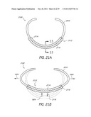 SELECTIVELY ADJUSTABLE CARDIAC VALVE IMPLANTS diagram and image