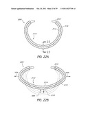 SELECTIVELY ADJUSTABLE CARDIAC VALVE IMPLANTS diagram and image