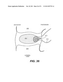 METHODS AND DEVICES FOR SPINAL DISC ANNULUS RECONSTRUCTION AND REPAIR diagram and image