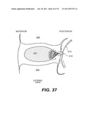 METHODS AND DEVICES FOR SPINAL DISC ANNULUS RECONSTRUCTION AND REPAIR diagram and image