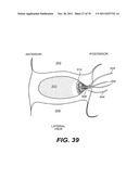 METHODS AND DEVICES FOR SPINAL DISC ANNULUS RECONSTRUCTION AND REPAIR diagram and image