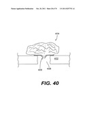 METHODS AND DEVICES FOR SPINAL DISC ANNULUS RECONSTRUCTION AND REPAIR diagram and image