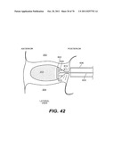 METHODS AND DEVICES FOR SPINAL DISC ANNULUS RECONSTRUCTION AND REPAIR diagram and image