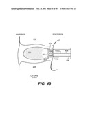 METHODS AND DEVICES FOR SPINAL DISC ANNULUS RECONSTRUCTION AND REPAIR diagram and image