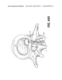 METHODS AND DEVICES FOR SPINAL DISC ANNULUS RECONSTRUCTION AND REPAIR diagram and image