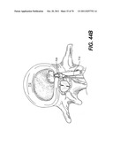 METHODS AND DEVICES FOR SPINAL DISC ANNULUS RECONSTRUCTION AND REPAIR diagram and image