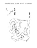 METHODS AND DEVICES FOR SPINAL DISC ANNULUS RECONSTRUCTION AND REPAIR diagram and image