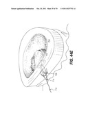 METHODS AND DEVICES FOR SPINAL DISC ANNULUS RECONSTRUCTION AND REPAIR diagram and image