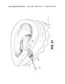 METHODS AND DEVICES FOR SPINAL DISC ANNULUS RECONSTRUCTION AND REPAIR diagram and image