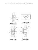 METHODS AND DEVICES FOR SPINAL DISC ANNULUS RECONSTRUCTION AND REPAIR diagram and image