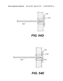 METHODS AND DEVICES FOR SPINAL DISC ANNULUS RECONSTRUCTION AND REPAIR diagram and image