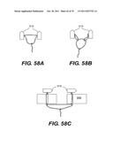 METHODS AND DEVICES FOR SPINAL DISC ANNULUS RECONSTRUCTION AND REPAIR diagram and image