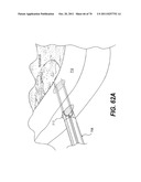 METHODS AND DEVICES FOR SPINAL DISC ANNULUS RECONSTRUCTION AND REPAIR diagram and image