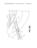 METHODS AND DEVICES FOR SPINAL DISC ANNULUS RECONSTRUCTION AND REPAIR diagram and image