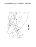 METHODS AND DEVICES FOR SPINAL DISC ANNULUS RECONSTRUCTION AND REPAIR diagram and image