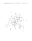 FORNIX MANIPULATOR diagram and image