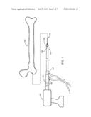 APPARATUS, SYSTEM, AND METHOD FOR HARVESTING IMPROVED BONE GRAFT MATERIAL     WITH REAMER-IRRIGATOR-ASPIRATOR (RIA) DEVICE diagram and image