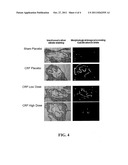 METHODS AND COMPOSITIONS FOR REDUCING OR PREVENTING VASCULAR CALCIFICATION     DURING PERITONEAL DIALYSIS THERAPY diagram and image