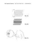 THREADS OF HYALURONIC ACID AND/OR DERIVATIVES, THEREOF, METHODS OF MAKING     THEREOF AND USES THEREOF diagram and image