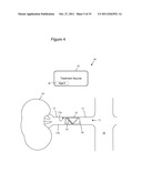 Patterned Denervation Therapy for Innervated Renal Vasculature diagram and image