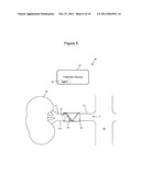 Patterned Denervation Therapy for Innervated Renal Vasculature diagram and image