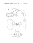 Patterned Denervation Therapy for Innervated Renal Vasculature diagram and image