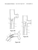 Patterned Denervation Therapy for Innervated Renal Vasculature diagram and image