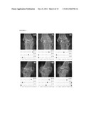  SCORING SYSTEM TO MONITOR NATURAL OR DRUG-MODIFIED DISEASE PROGRESSION IN      EROSIVE OSTEOARTHRITIS  OF THE INTERPHALANGEAL FINGER JOINTS diagram and image