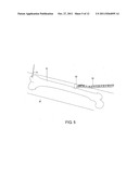 Assisted Positioning Device for Bone Plate diagram and image