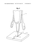 VEIN REMOVAL DEVICE diagram and image