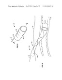 INTRODUCER SHEATHS, THROMBUS COLLECTION DEVICES AND ASSOCIATED METHODS diagram and image