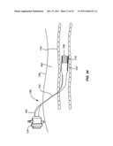 INTRODUCER SHEATHS, THROMBUS COLLECTION DEVICES AND ASSOCIATED METHODS diagram and image