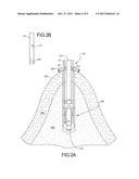 Flexible Anchors for Tissue Fixation diagram and image