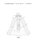 Flexible Anchors for Tissue Fixation diagram and image