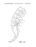 METHOD AND APPARATUS FOR SPINAL STABILIZATION diagram and image