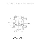 METHOD AND APPARATUS FOR SPINAL STABILIZATION diagram and image