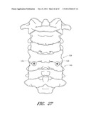 METHOD AND APPARATUS FOR SPINAL STABILIZATION diagram and image