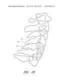 METHOD AND APPARATUS FOR SPINAL STABILIZATION diagram and image