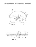 EXPANDABLE ARTHROPLASTY PLATES diagram and image