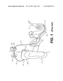 COCHLEAR IMPLANT COMPONENT HAVING A UNITARY FACEPLATE diagram and image