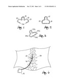 Spinal Cord Stimulator Lead Anchor diagram and image