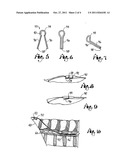 Spinal Cord Stimulator Lead Anchor diagram and image