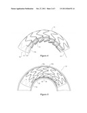 CURVE FORMING STENT GRAFT diagram and image